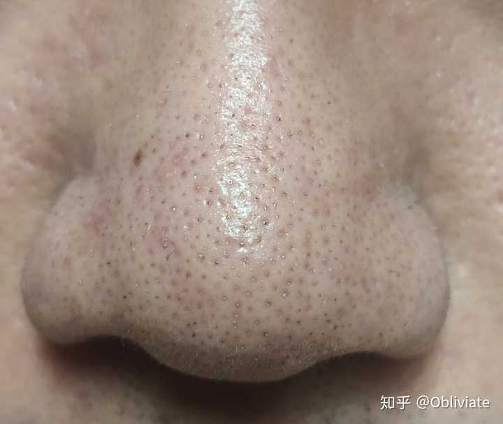 请问这是黑头吗要怎么去除呀