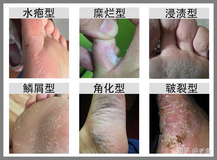 中国50%的脚气患者,为什么治疗的人不足十分之一?