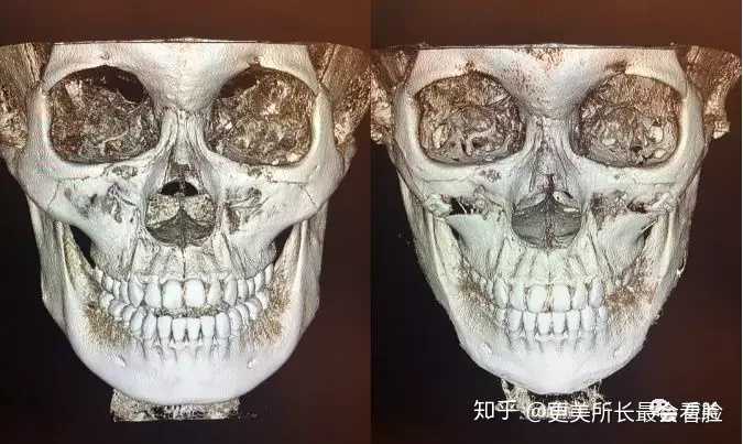 磨颧骨到底会不会下垂呀