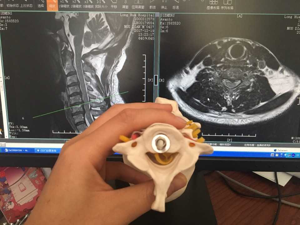 颈椎核磁共振图片图解正常颈椎核磁共振图颈椎的核磁共振的图解脊髓