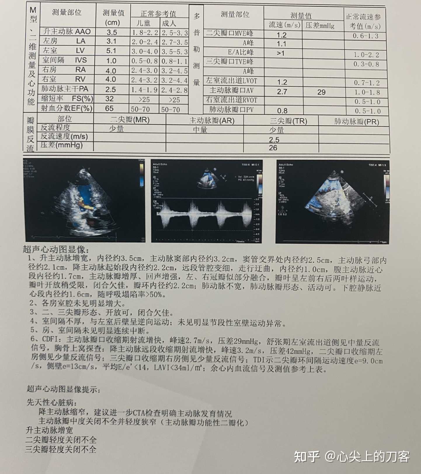 二叶式主动脉瓣畸形是指主动脉的瓣叶部分融合导致本身3个瓣叶的结构