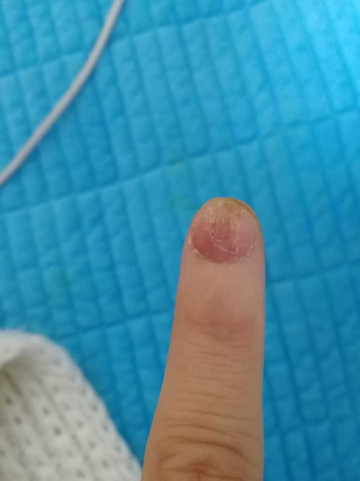 手经过长期的啃咬,变成了这样,千疮百孔,怎么办?很恶心很恐怖?