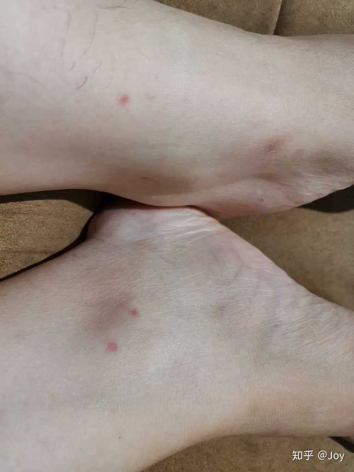 为什么我被蚊子咬了不起包,只有一个小红点,是什么原因?