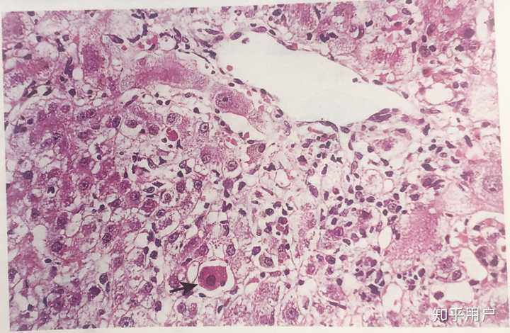 为什么病毒性肝炎肝细胞都是细胞水肿,但是还有一些细胞失水皱缩嗜酸