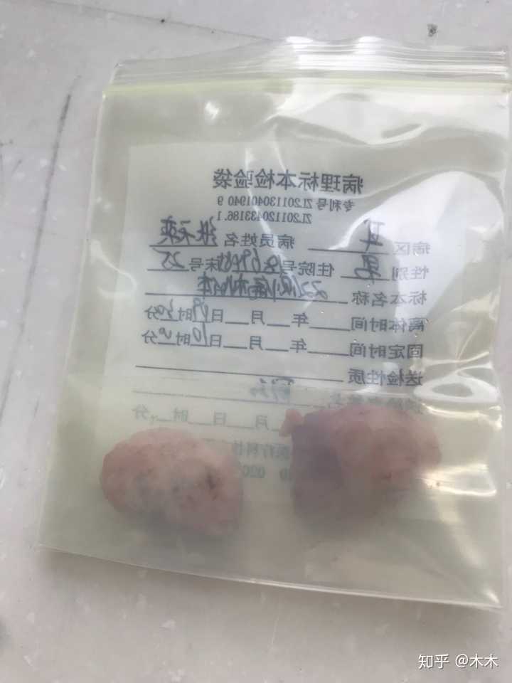 做完扁桃体切除手术后是什么体验