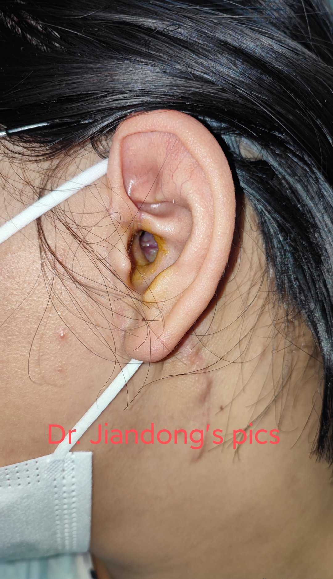 李健东大夫 的想法: 外耳道闭锁,这是术后半年的样子