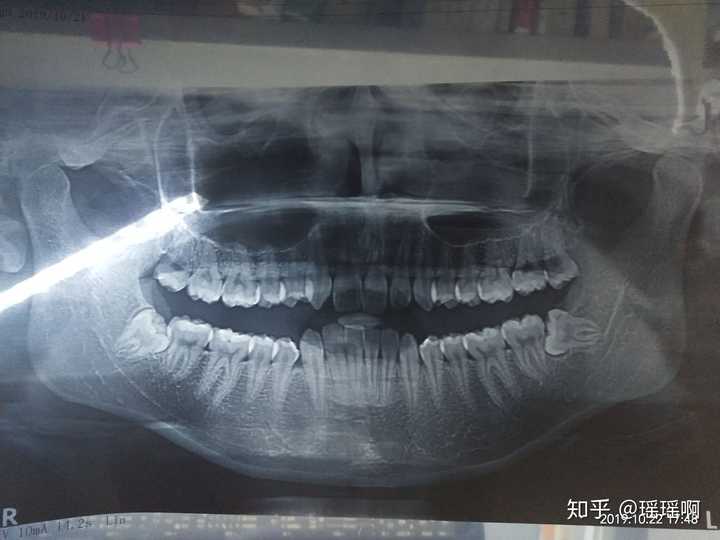 拔智齿和拔完智齿是怎样一种体验?