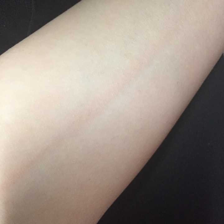 人工荨麻疹(皮肤划痕症)的原理是什么?有治疗的必要么