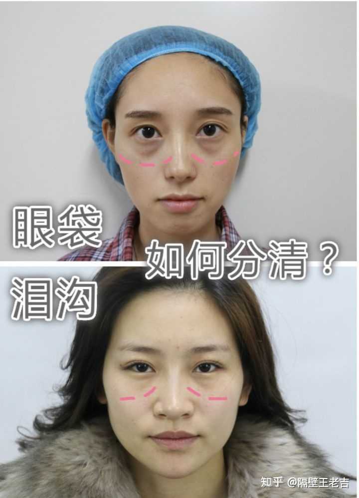 颧骨高,脸颊凹陷微整形能纠正吗?