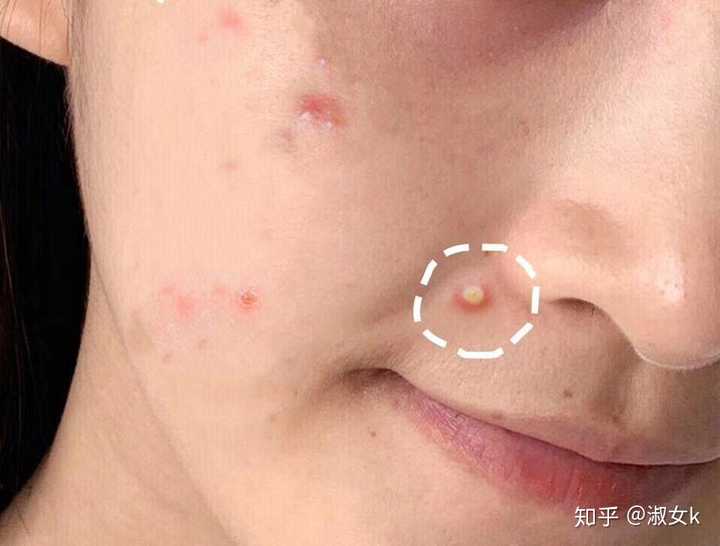 特别是这种白色的痘痘,闺蜜说这是痤疮