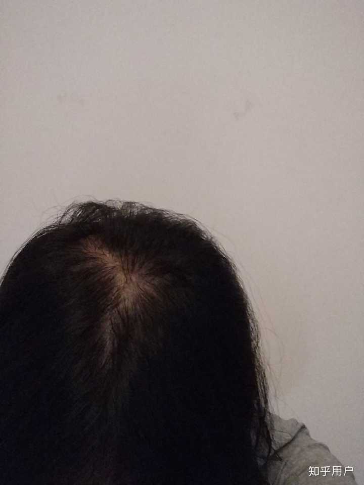 女生头顶头发少是什么体验 ?