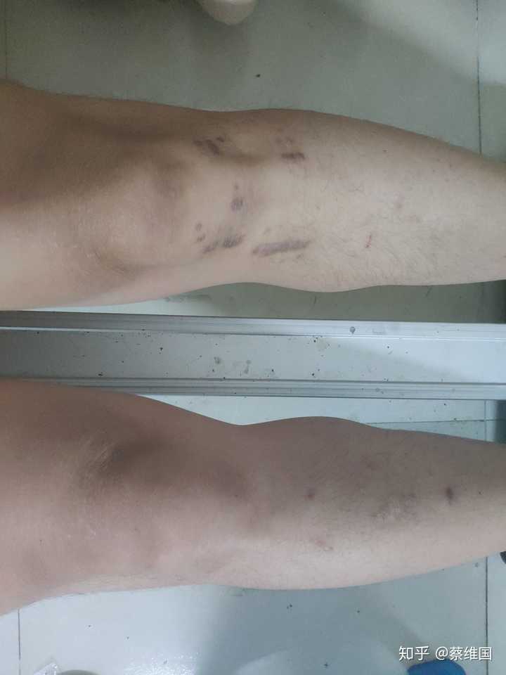 前交叉韧带重建术后恢复是一种怎样的体验?