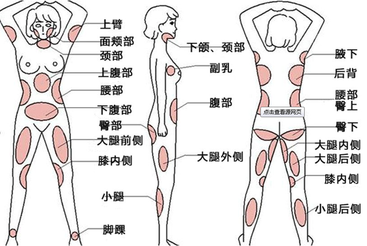腿部吸脂是永久的吗?
