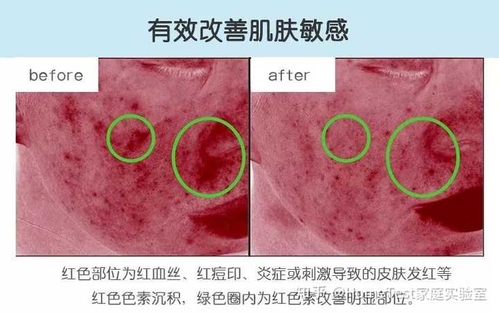 指对皮肤中红血丝,红痘印等红色色素沉积的改善 图片来源于hometest丁