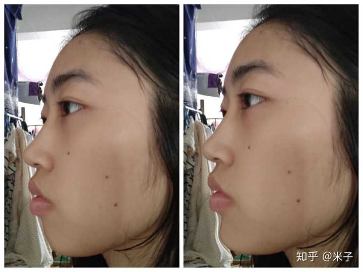 下巴后缩星人亲身经历?