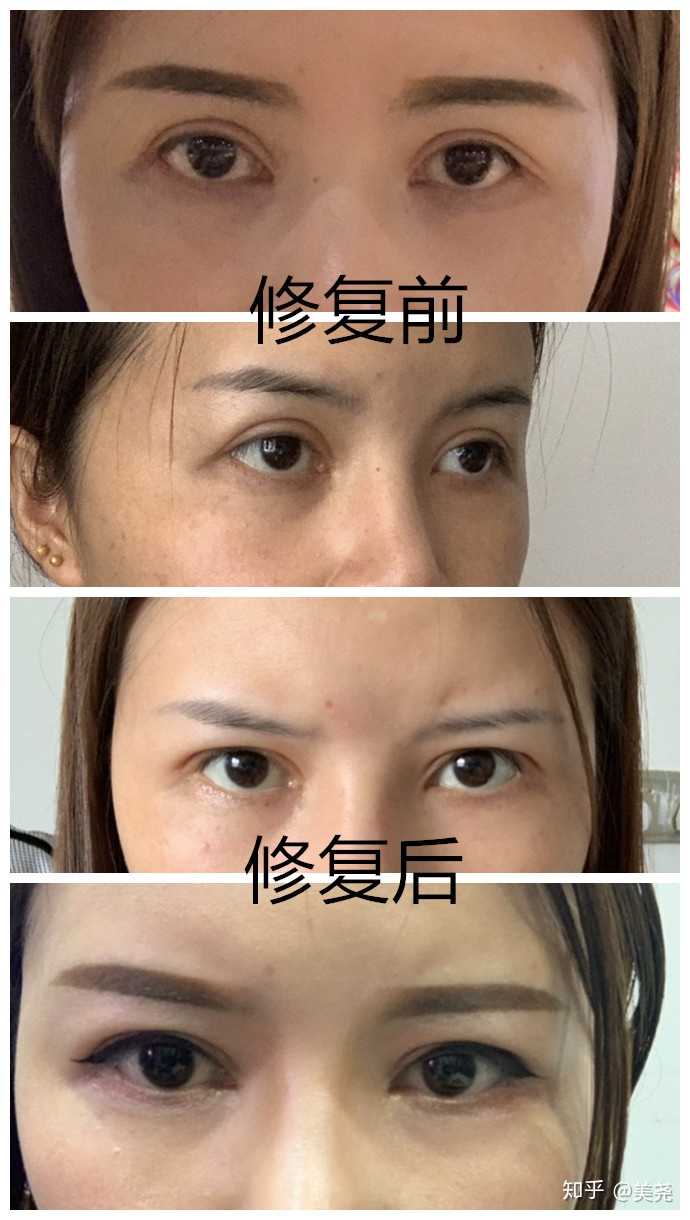 全切双眼皮修复有多难?