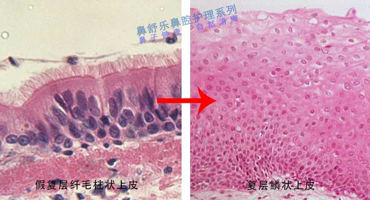 鼻腔内黏膜由假复层柱状纤毛上皮转化为无纤毛的复层鳞状上皮,腺体