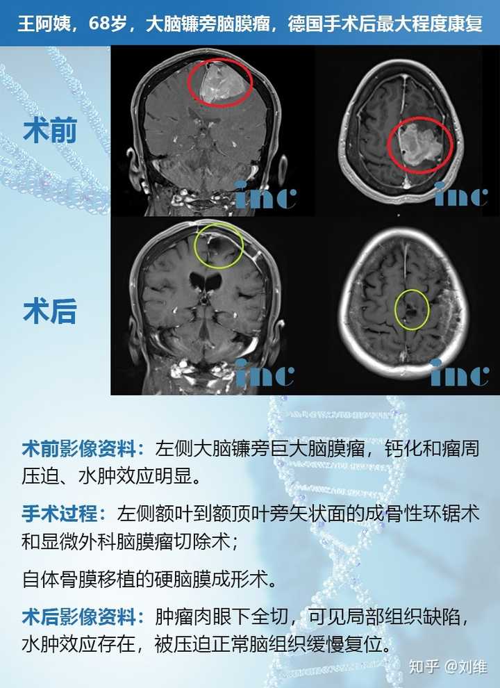 恶性脑膜瘤表现出细胞异常增加,并且以比良性和非典型脑膜瘤更快的