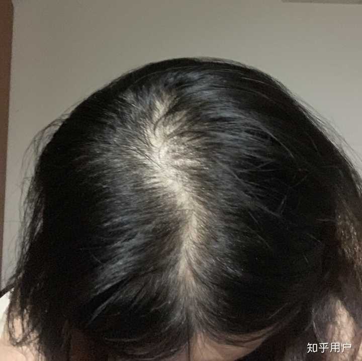 女生头顶头发少是什么体验 ?