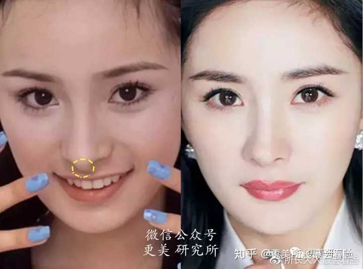 做过缩鼻头鼻翼的小仙女有什么感受吗?