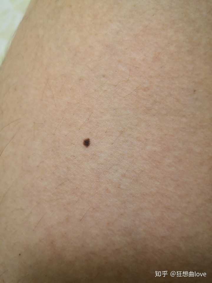 身上忽然长出很多小黑点.这是什么?