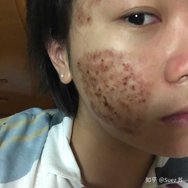 点阵激光祛痘印有效吗? - 知乎