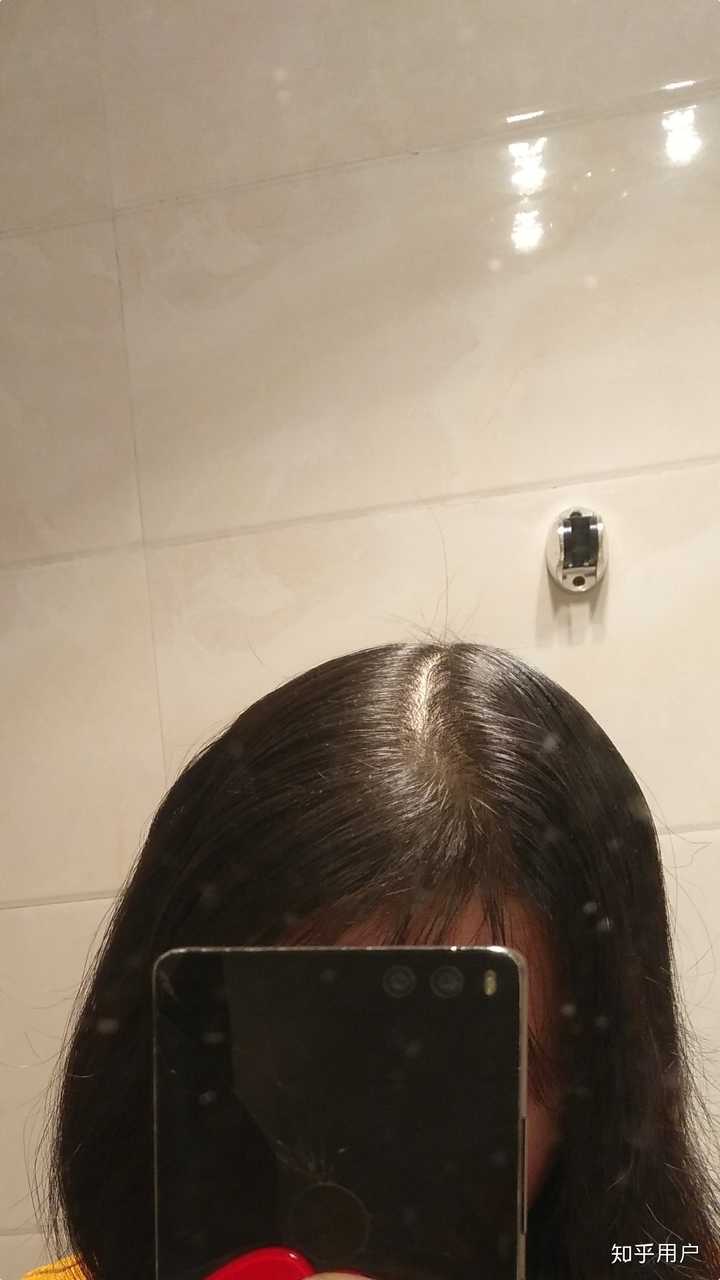 女生秃顶是怎样一种体验?