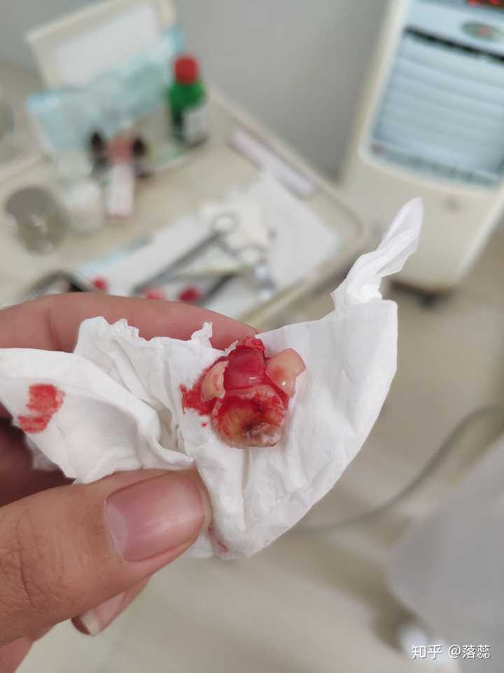 拔完智齿以后的痛来说说?