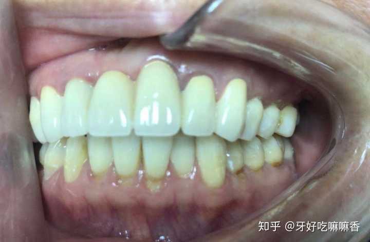 旁边两颗健康的牙齿虽然磨掉了一些,但是不会造成其他的不良影响.
