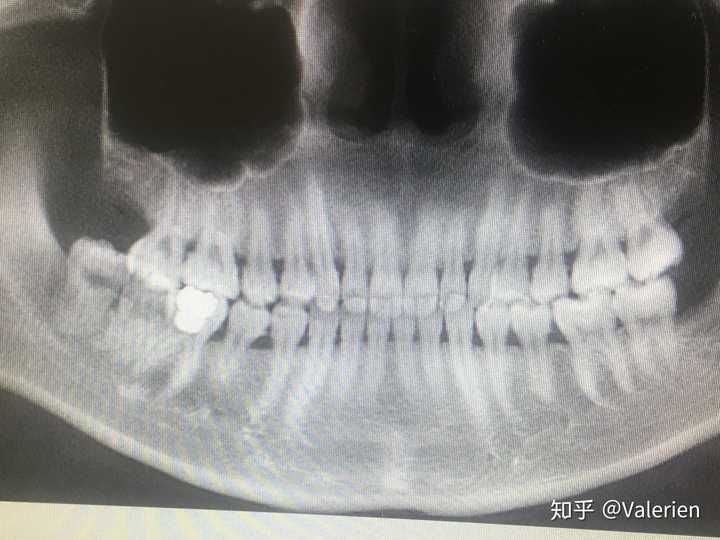 有下磨牙缺失一颗后用智齿前移的病例吗