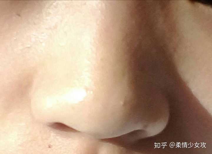 还有比我更惨的吗 蒜头鼻    而且鼻孔那里有颗痣看起来像鼻屎.