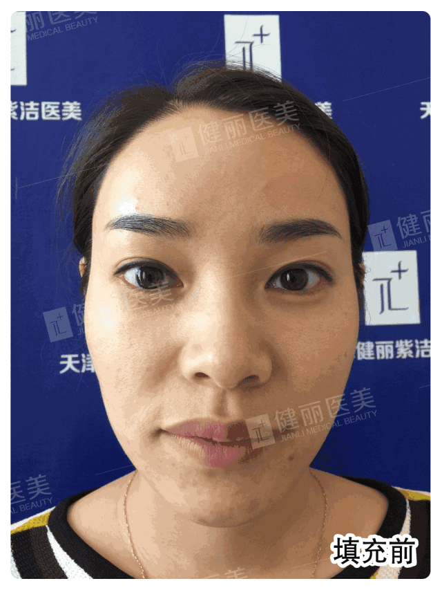 脸颊凹陷怎么办?