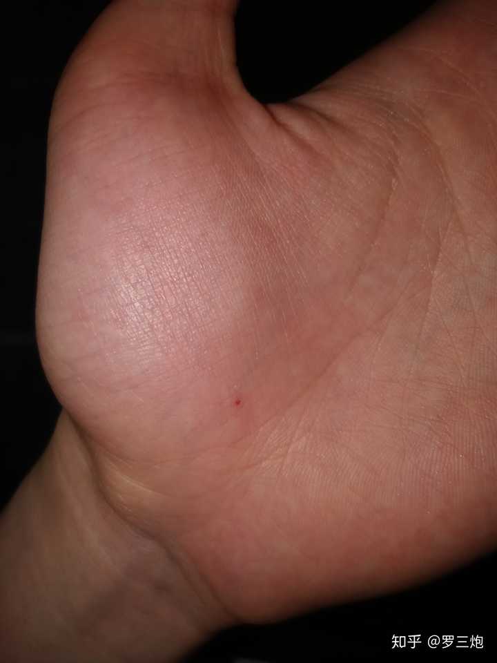 手上有红点 很多年都没有消,是什么来的?