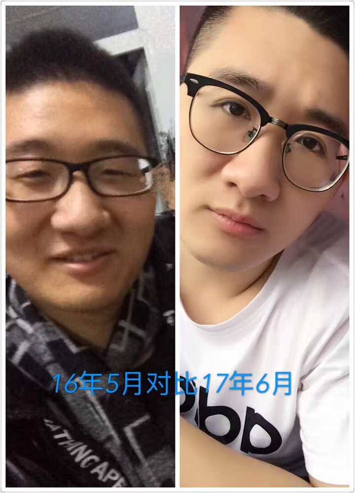 男生做双眼皮手术是什么体验?
