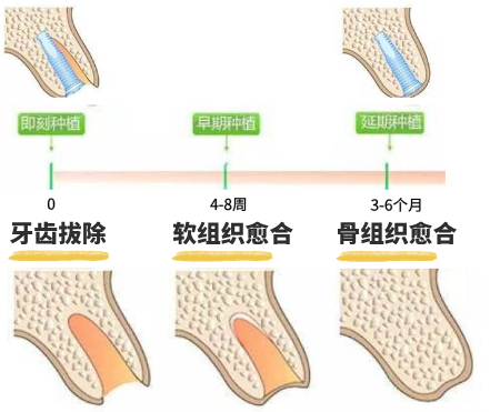 因为种植体与拔牙窝的形态大小不一致,会产生明显的间隙,需要大量的