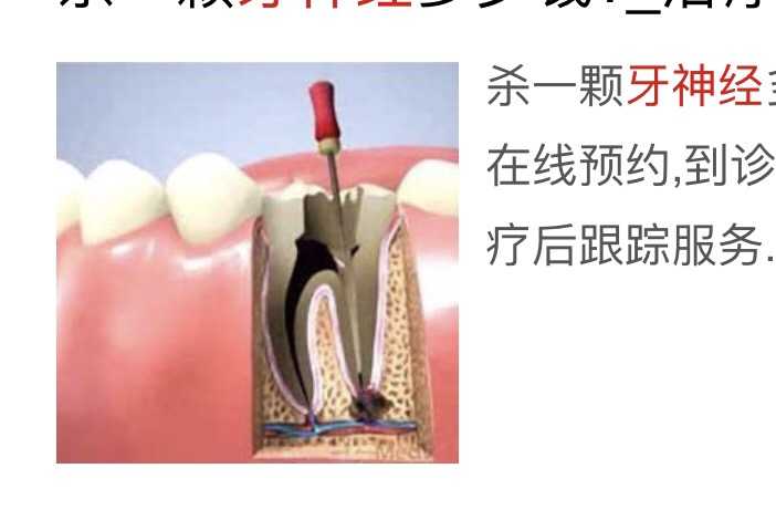 一口烂牙牙医说你这个后槽牙已经蛀到牙髓了,只能把牙髓拿掉然后填充