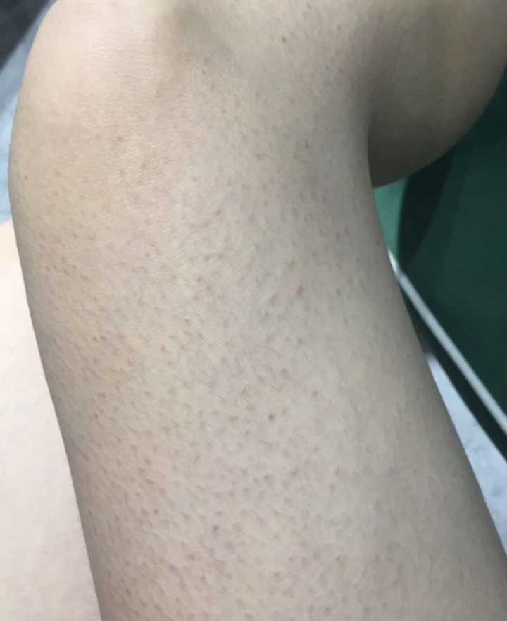 有一个有鸡皮肤的女朋友有什么体验?