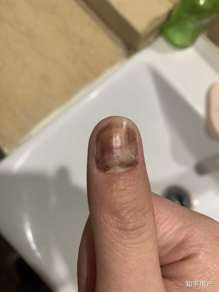 将近两个月上面的指甲在一次洗澡之后全掉了,但里面的畸形小指甲还没