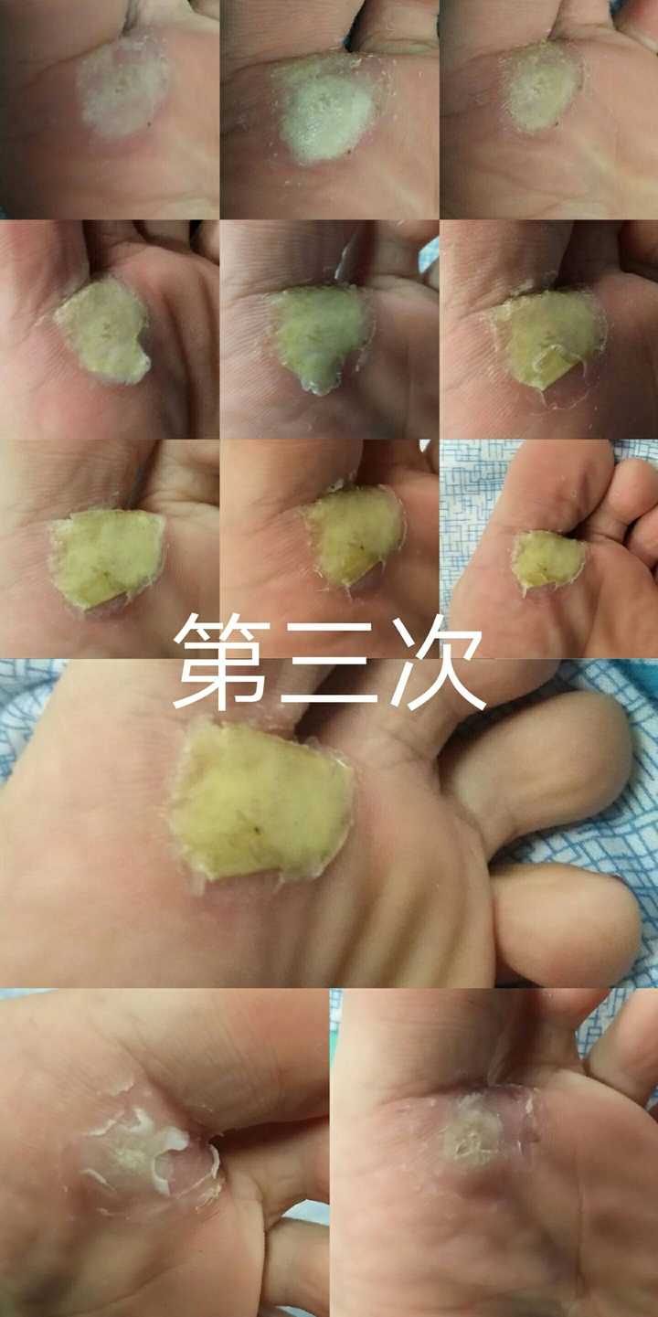 跖疣如何治疗?