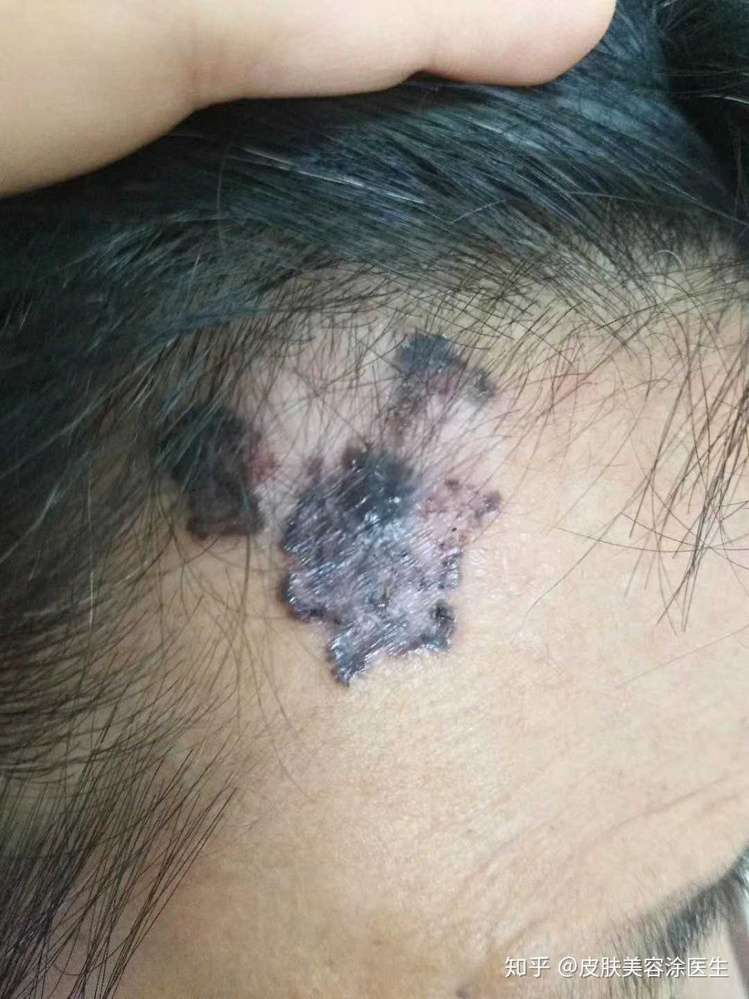 痣也不要随便乱点,必须要专业的皮肤科医生确定良性的才能点.