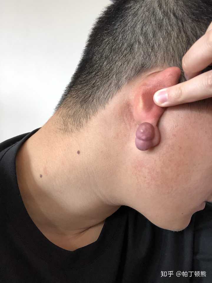 耳朵瘢痕疙瘩切除手术整个下来大概多少钱?