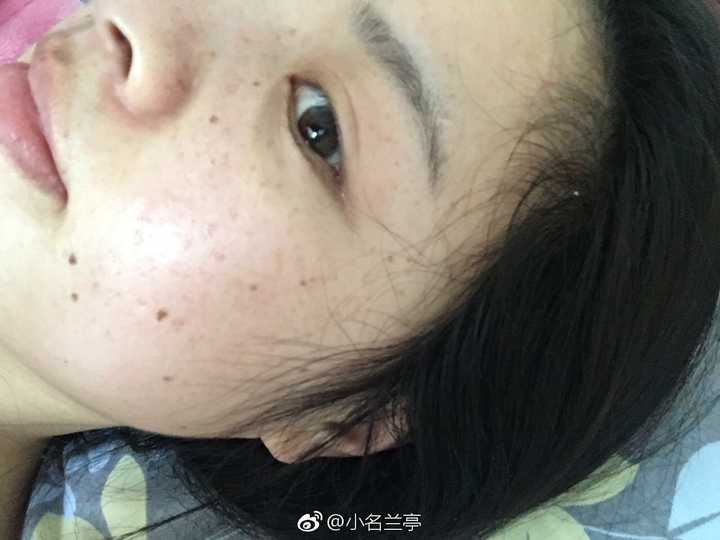 脸上有雀斑是一种什么体验