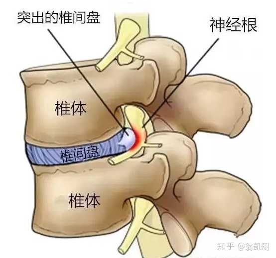 17岁得颈椎病还有救吗?