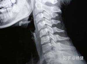 如果你的颈部向前伸,头不在肩膀的正上方,那么你可能有我们今天要说的