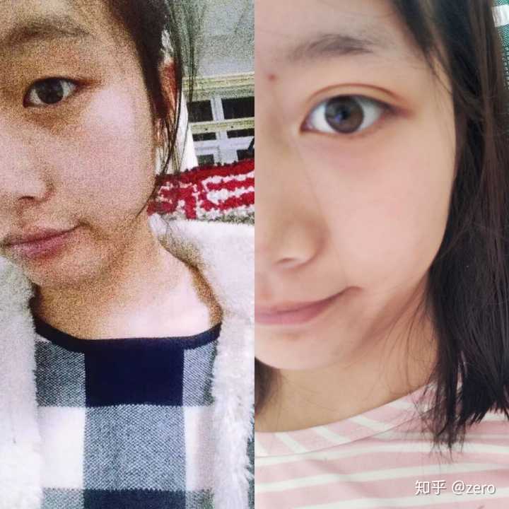 为什么有的人单眼皮长着长着自然就成双眼皮了?