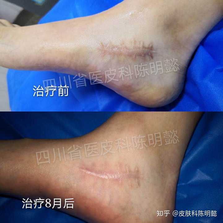 我手腕上不小心落下了疤痕,很像割腕的痕迹,超级尴尬的,请问有什么