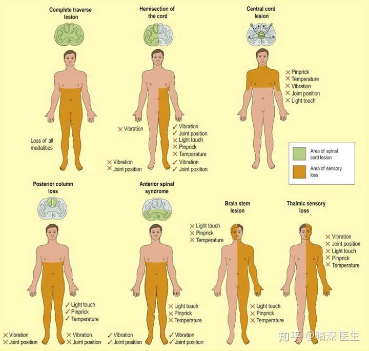 为什么丘脑病变时,深感觉和精细触觉障碍重于浅感觉?