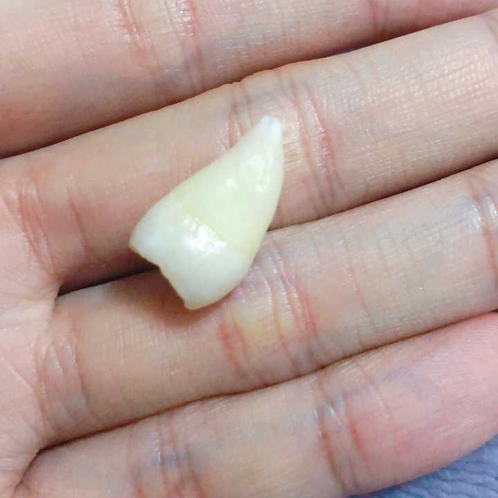 为什么有人拔牙智齿这么便宜