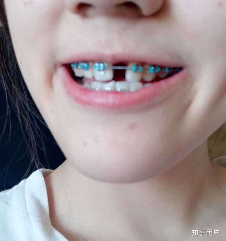 没有门牙是怎样的体验?