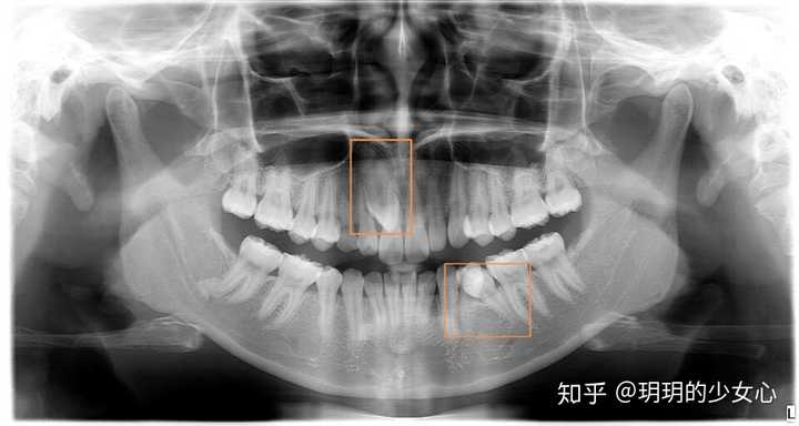 为什么上颚会长出牙齿?